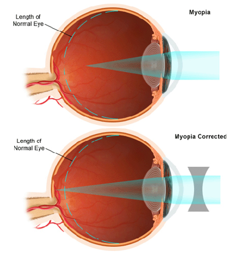 myopia lens